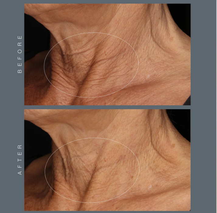 dermalogica neck fit contour serum