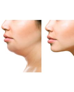 Aesthetic Angulation Package - Jawline and Chin Augmentation £479 (Save £119)